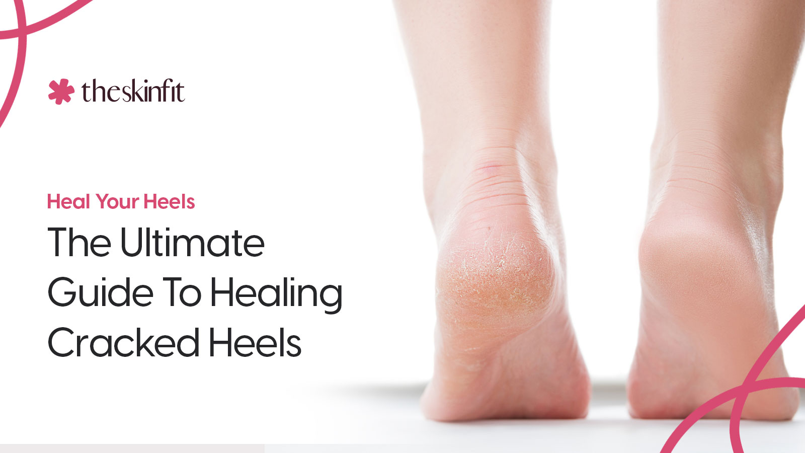 Heal Your Heels: The Ultimate Guide To Healing Cracked Heels
