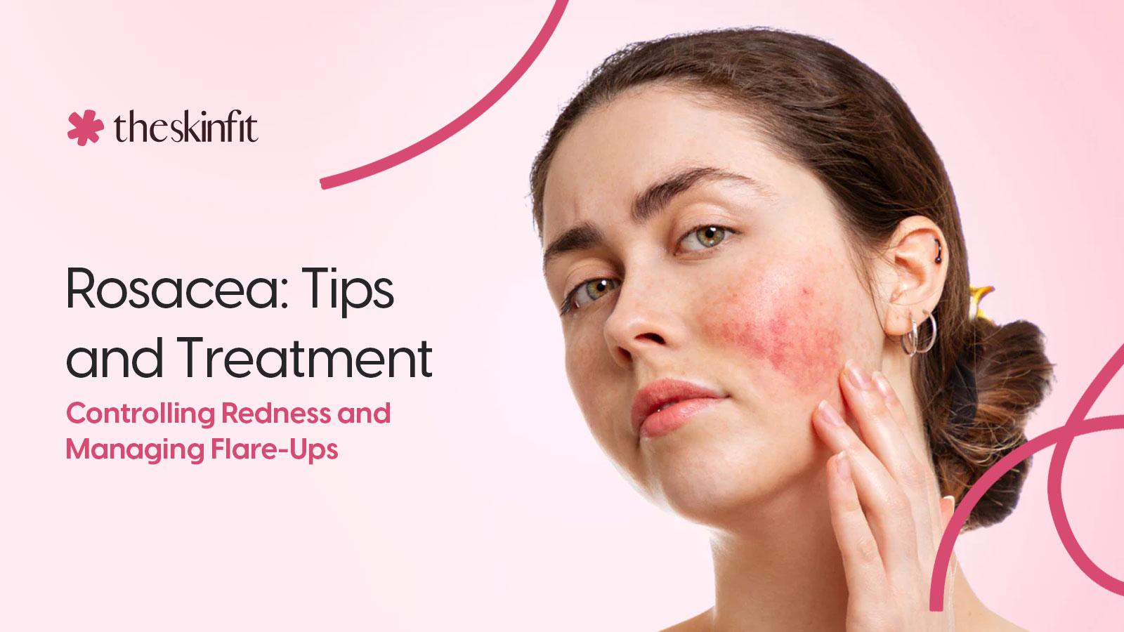 How To Treat And Manage Rosacea's Redness And Flare-Ups 